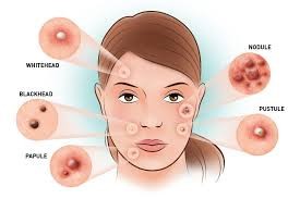 diagram of acne types