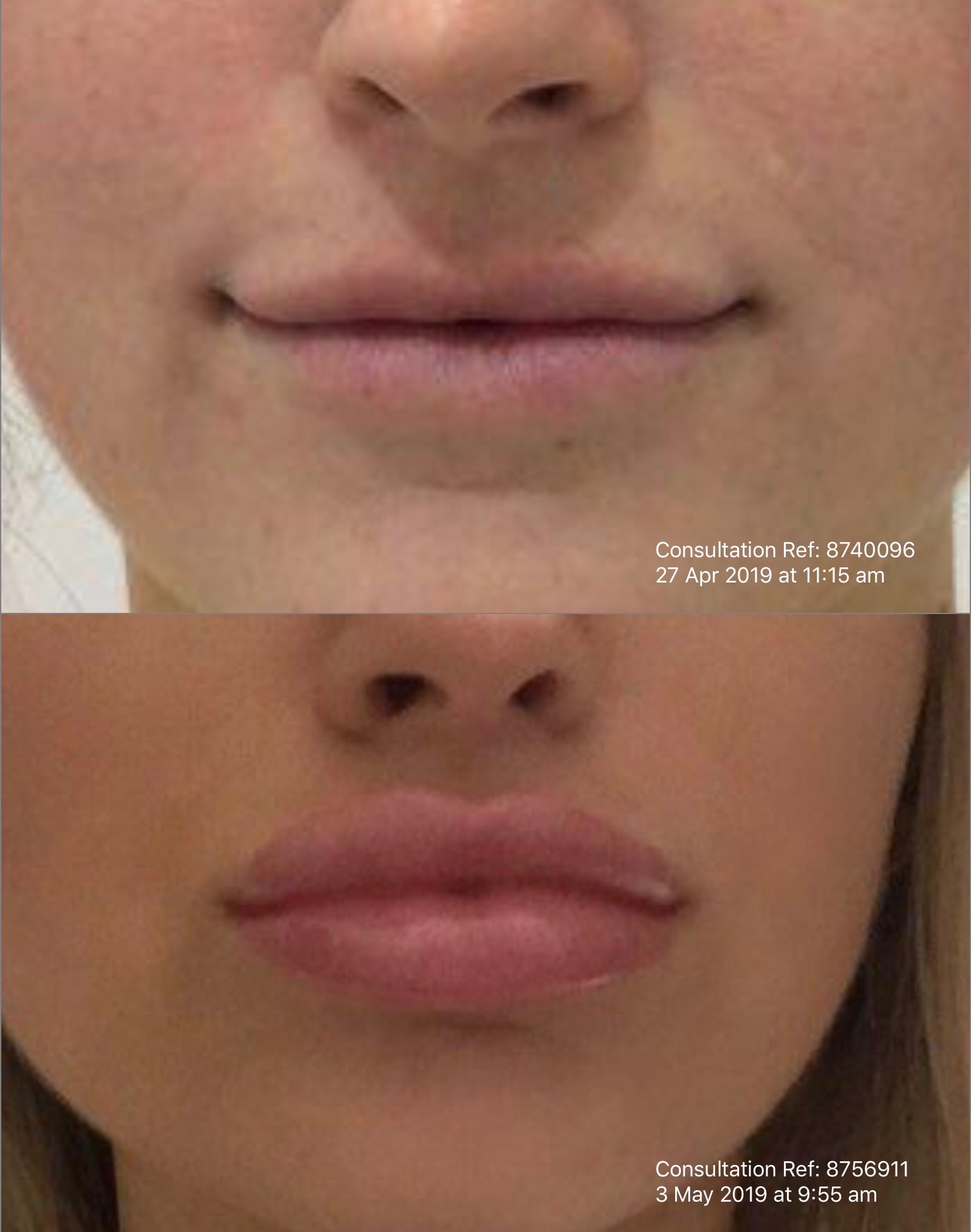 Lip Enhancement Injectables Gold Coast Oo La La Cosmetic & Laser Clinic